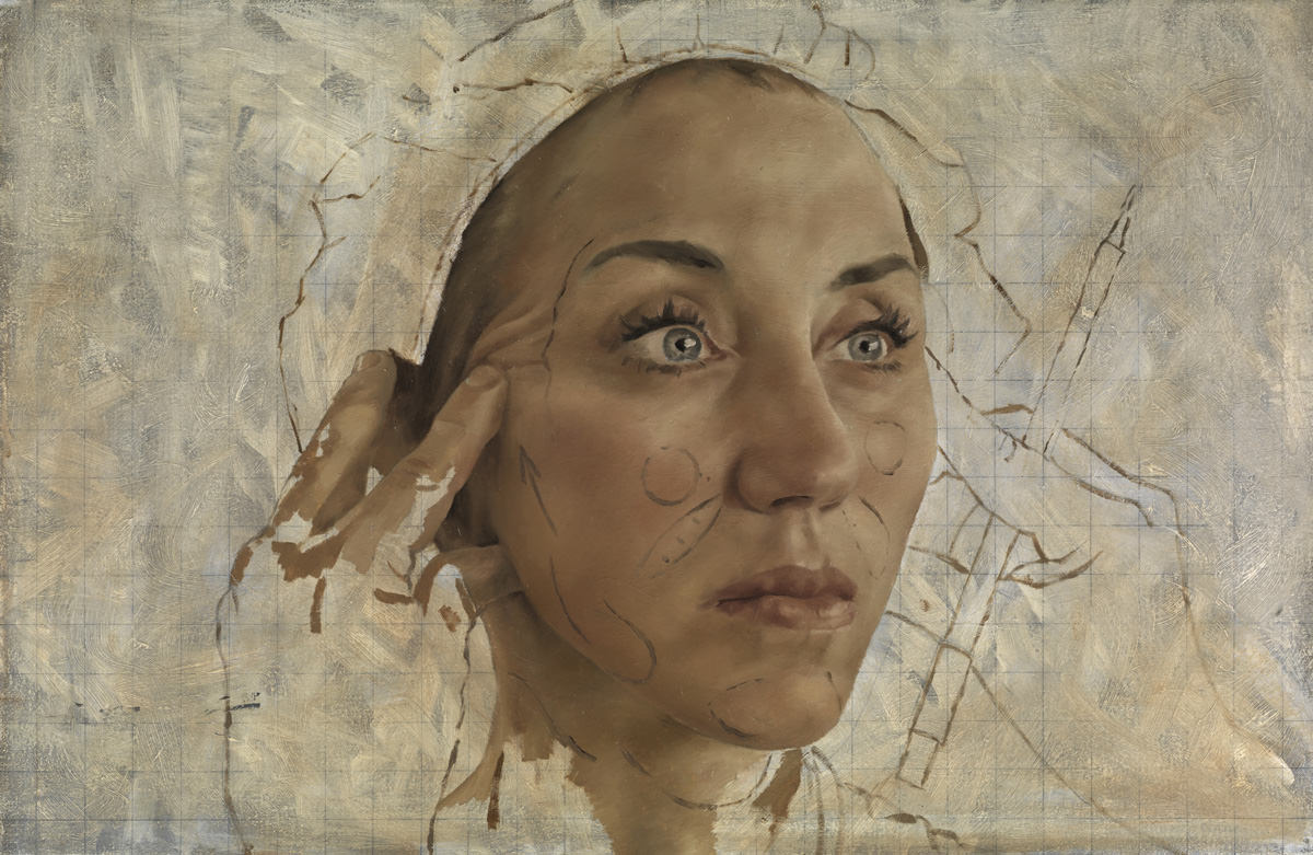 Rhytidectomy Iii With Surgeons Hands 7319